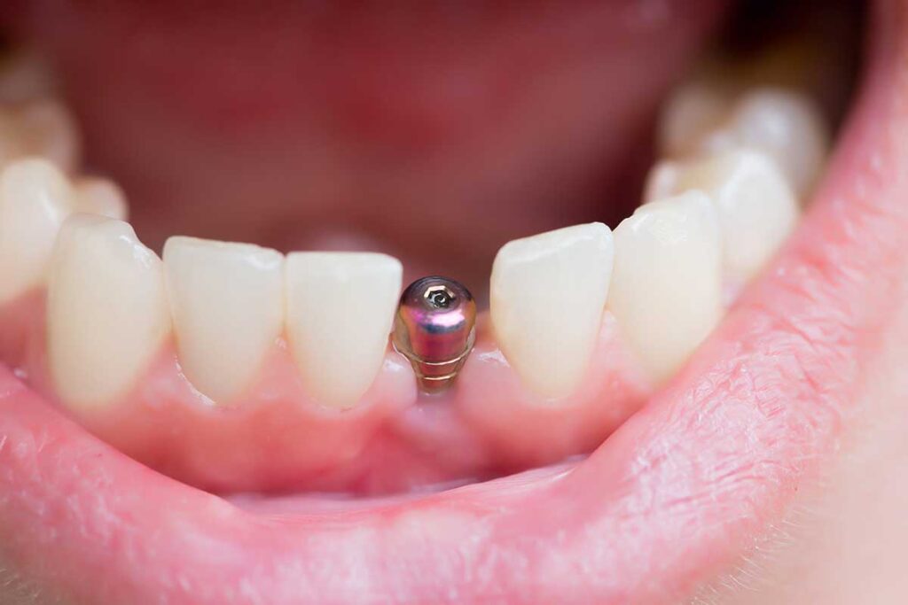 Implante dental
