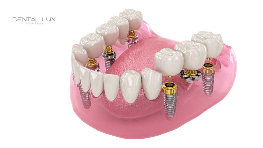 All-on-X in Cartagena, Colombia.