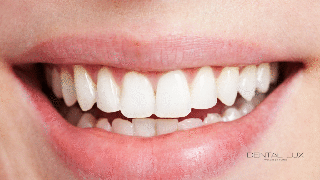 Diseño de sonrisa en Dental Lux